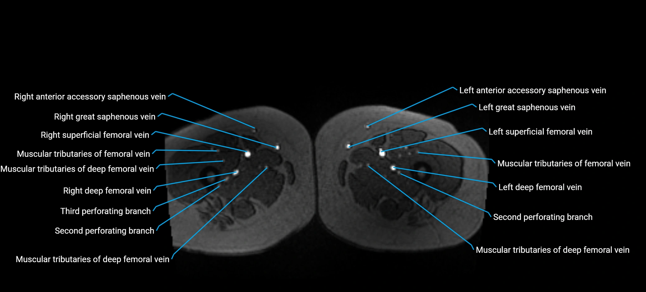 MRV abdomen pelvis & lower limb axial cross sectional anatomy labelled MRI image 237 (1).webp